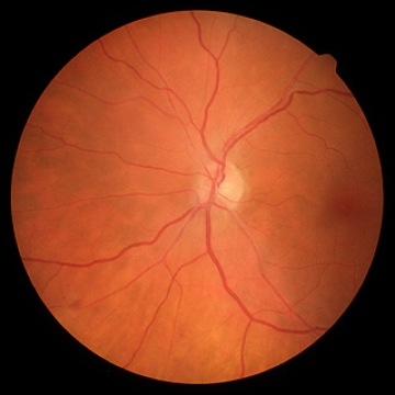 Retinal scan of the eye using an optical tomography
